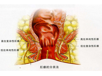 肛瘘是怎么回事