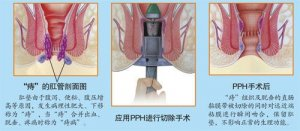 肛门直肠异物是怎么回事--肛门直肠异物该怎么