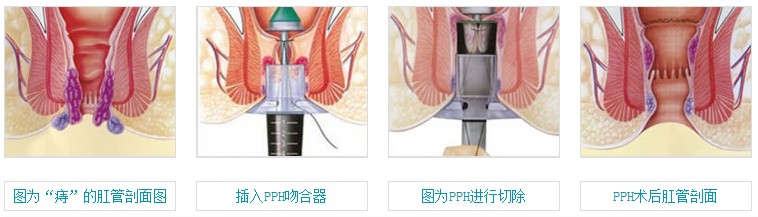 图示博仕“PPH无刀除痔”治疗过程 图示博仕“PPH无刀除痔”治疗过程