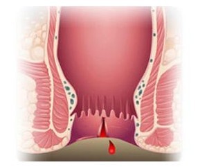 拉大便出血怎么办_便血_武汉肛肠医院