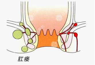 肛瘘是怎么回事