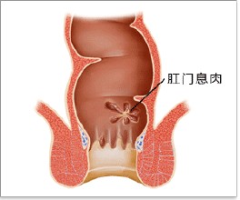 直肠息肉