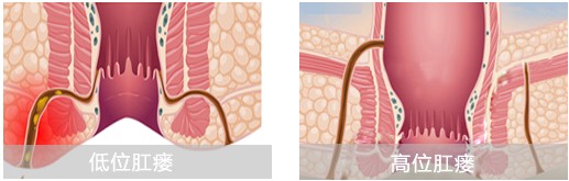肛瘘分类病理