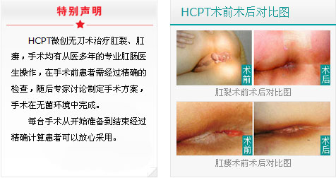 HCPT治疗肛裂