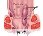 内痔疮症状图片