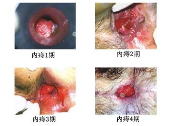 内痔疮症状图片