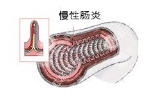 慢性肠炎