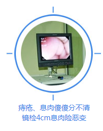 痔疮息肉检查