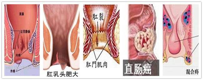 大便变细疾病