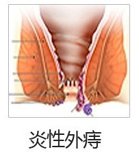 炎性外痔