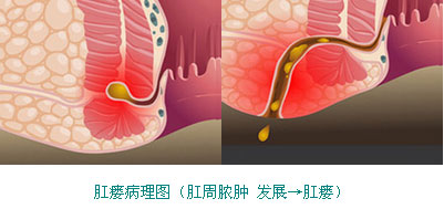 肛瘘
