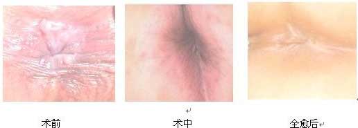 微创术治疗