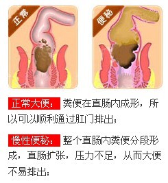 便秘症状