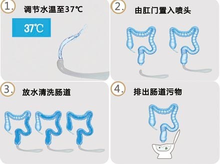 大肠水疗