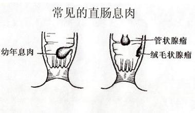 息肉症状