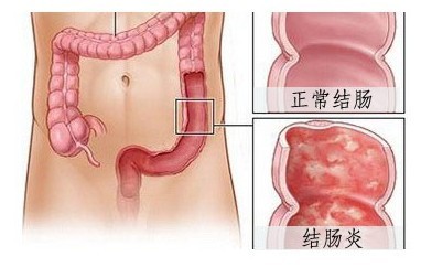 结肠炎