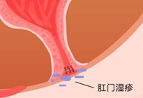 肛门湿疹