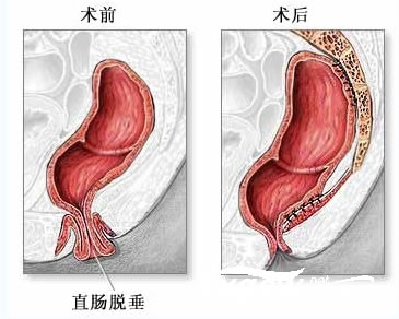 脱肛治疗