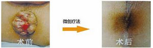 微创手术