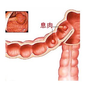息肉