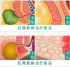 肛周脓肿治疗前后对比