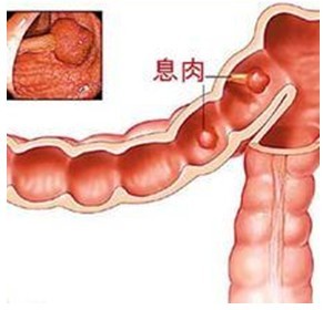 息肉