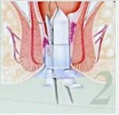 pph2