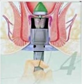 pph4