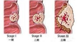 乙状结肠炎