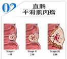 直肠平滑肌肉liu