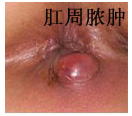 肛周脓肿