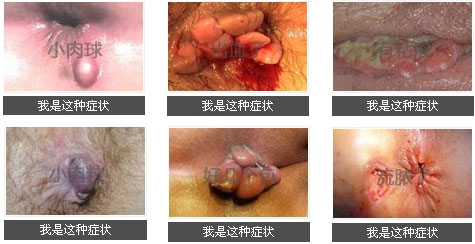 屁股长包、疙瘩、痘痘