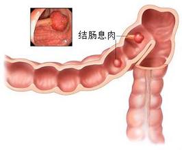 结肠息肉