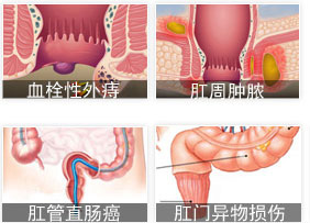 肛门内部疼的病因