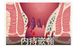 内痔嵌顿