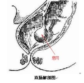 直肠息肉