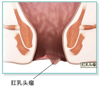 肛乳头liu