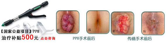 pph微创术