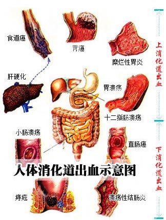 便血消化道出血