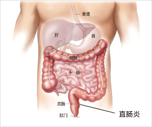 直肠炎