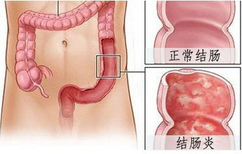 结肠炎