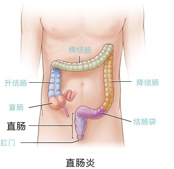 慢性直肠炎