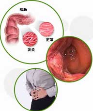结肠炎
