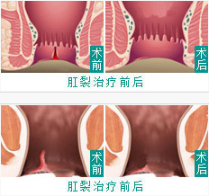 肛裂前后