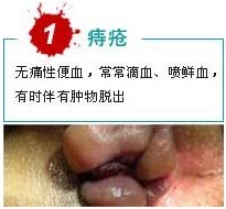 痔疮出血