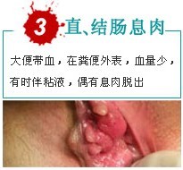 息肉出血