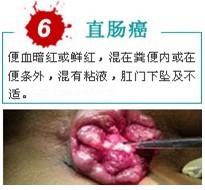 肠癌出血
