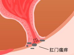 肛门瘙痒