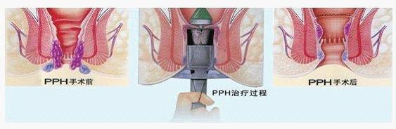pph微创术
