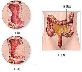 息肉危害